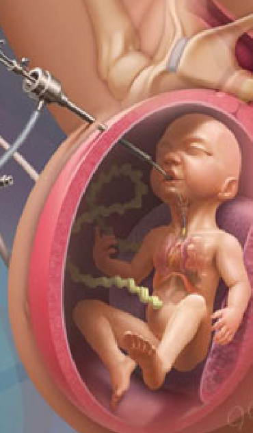 Fetal Diagnostic Procedures in Prabhadevi Chembur Mumbai