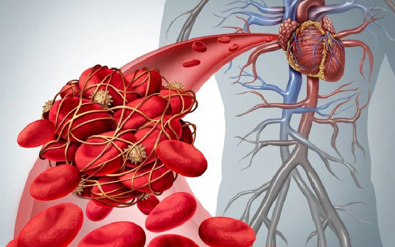 Clotting disorders pregnancy