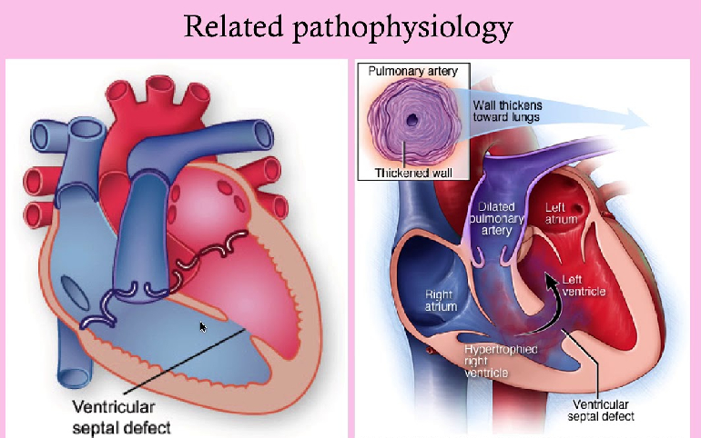 Cardiac disease in pregnancy
