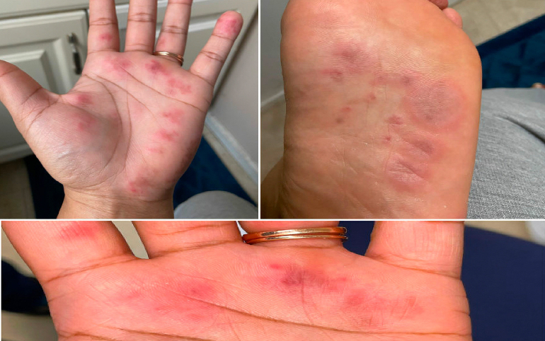 Autoimmune disorders pregnancy Mumbai